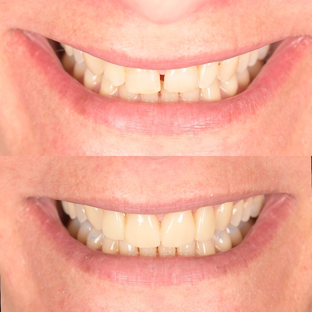 Sorriso prima e dopo un trattamento estetico